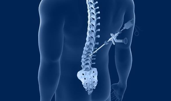 Medical illustration showing minimally invasive spine surgery being performed on the lower back.