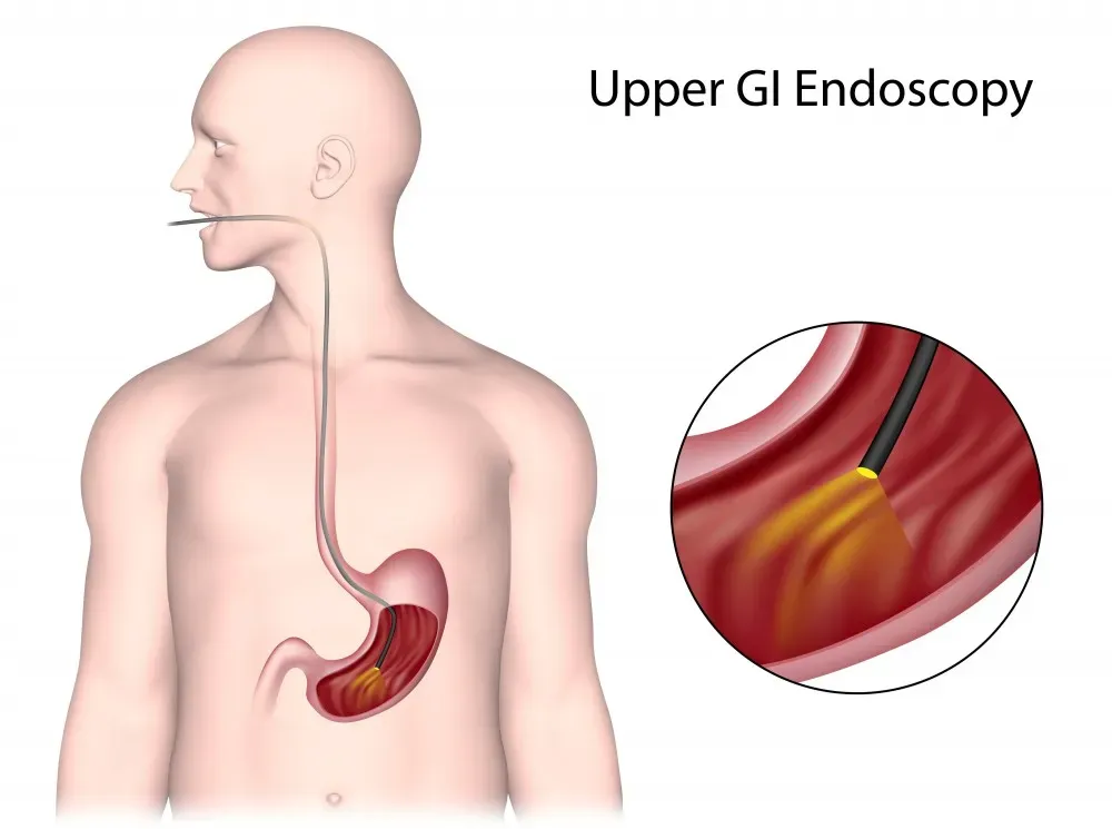 Illustration of an upper GI endoscopy procedure showing an endoscope inserted through the mouth into the stomach