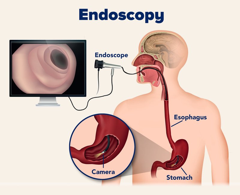 Medical illustration showing an endoscopy procedure using an endoscope inserted through the mouth to examine the esophagus and stomach.