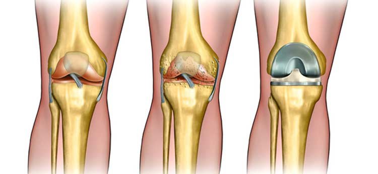 Medical illustration showing stages of knee joint damage and total knee replacement surgery.