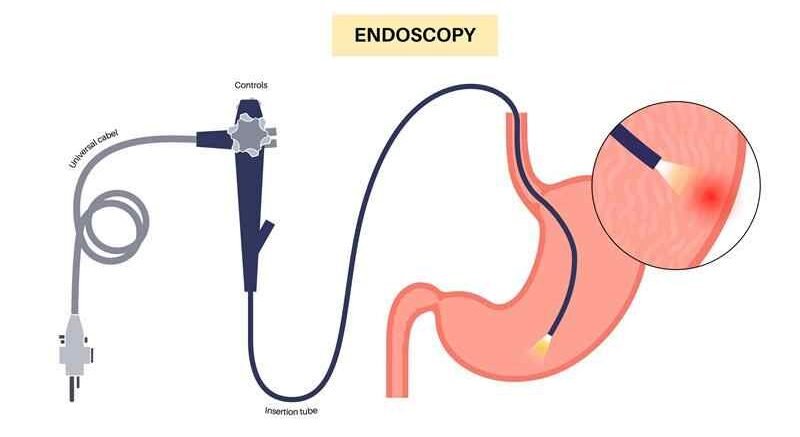 Illustration of an endoscopy procedure showing a flexible endoscope examining the stomach lining.
