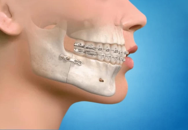 Illustration showing corrective jaw surgery with dental braces and jaw fixation plates on the lower jaw.