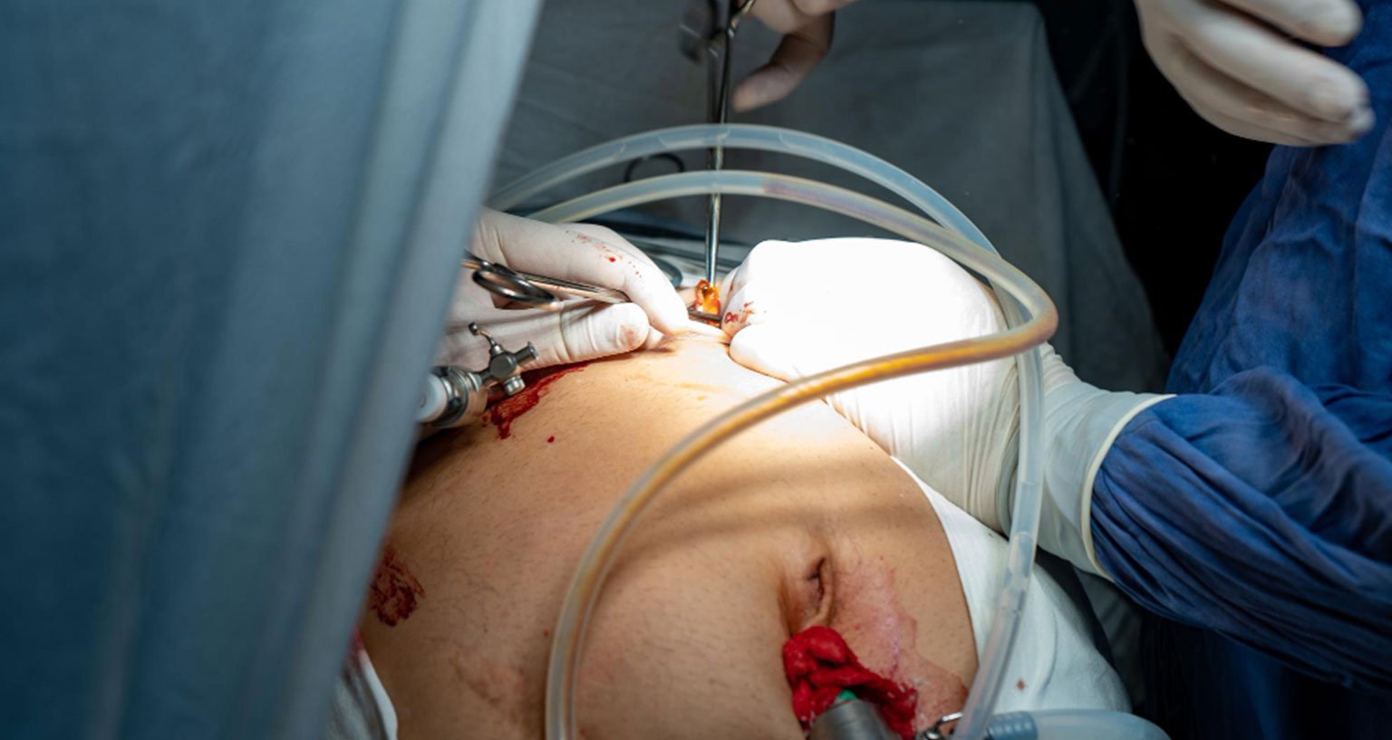 Surgeon performing a minimally invasive laparoscopic procedure using surgical instruments and a camera.