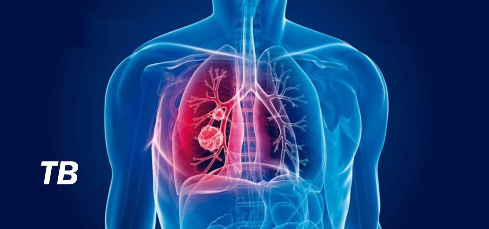Medical image of lungs affected by tuberculosis (TB) with highlighted infected areas in the respiratory system.